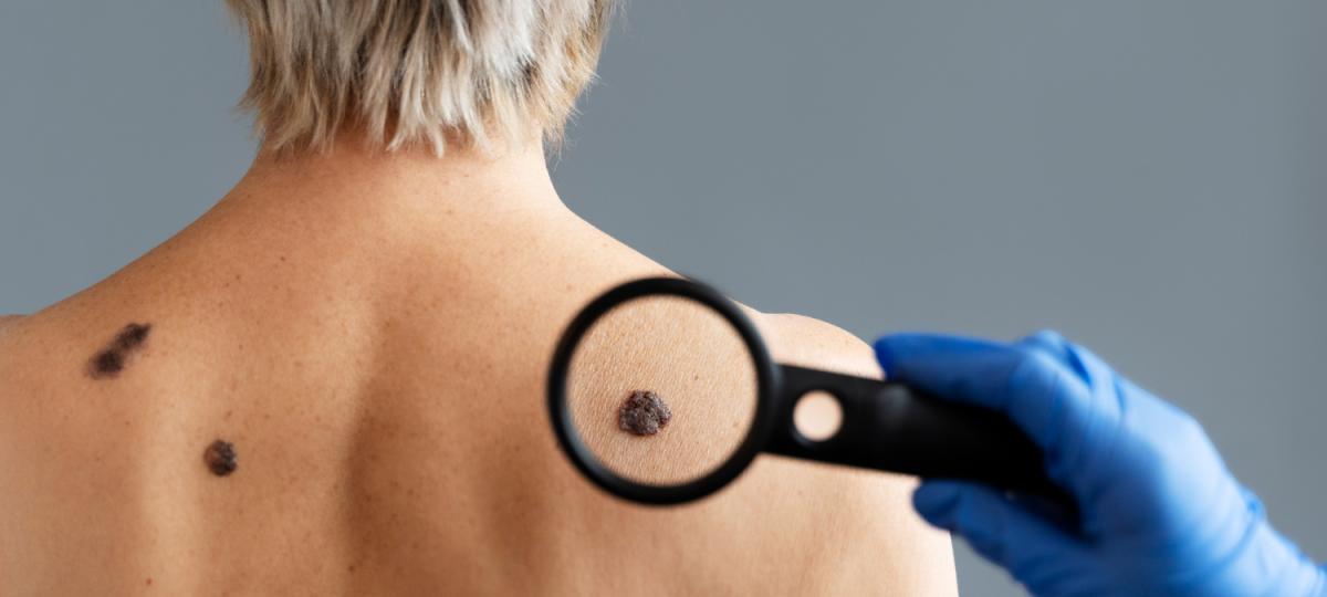 Usuwanie zmian - włókniaki