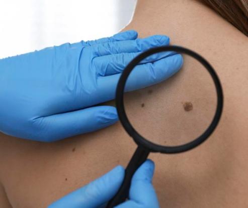 usuwanie zmian w Płocku - pieprzyki